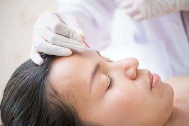 Tratamiento natural de acupuntura para migrañas: testimonio de María, quien superó sus dolores de cabeza gracias a la medicina natural y la homeopatía